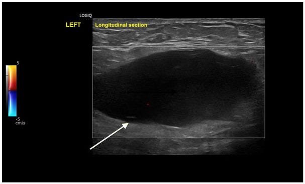 Hernia parte IV Ecografia tempo formacion.jpg